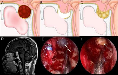 Strategy of skull base reconstruction after endoscopic transnasal pituitary adenoma resection